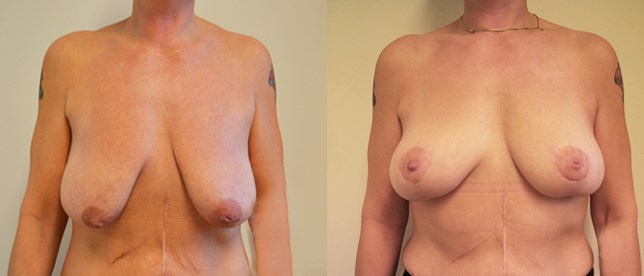 Bröstlyft - före och efter