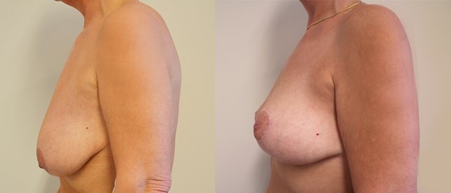 Bröstlyft - före och efter