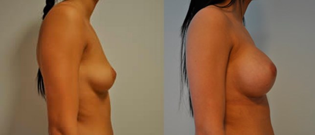 Bröstförstoring före och efter