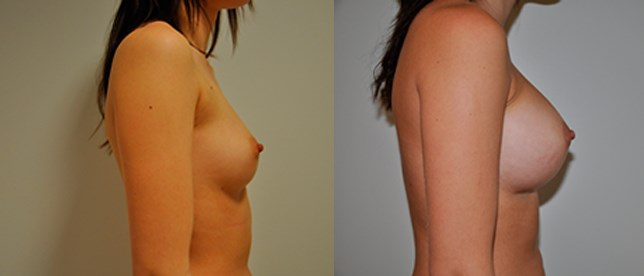 Bröstförstoring före och efter