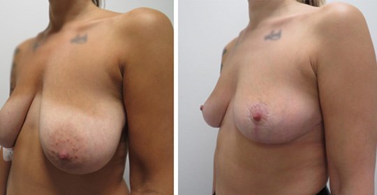 Före- och efterbilder bröstförminskning och bröstlyft