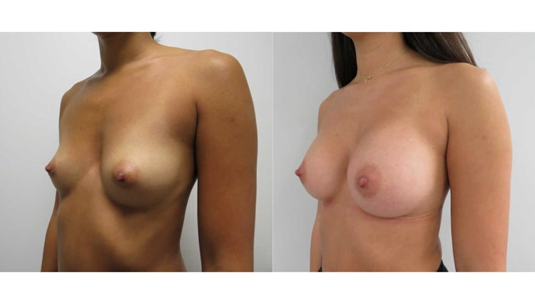 Före- och efterbilder bröstförstoring